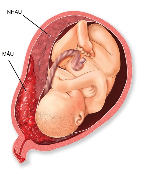 Đau bụng dưới tuần 36 thai kỳ có thể là dấu hiệu bong nhau non nguy hiểm
