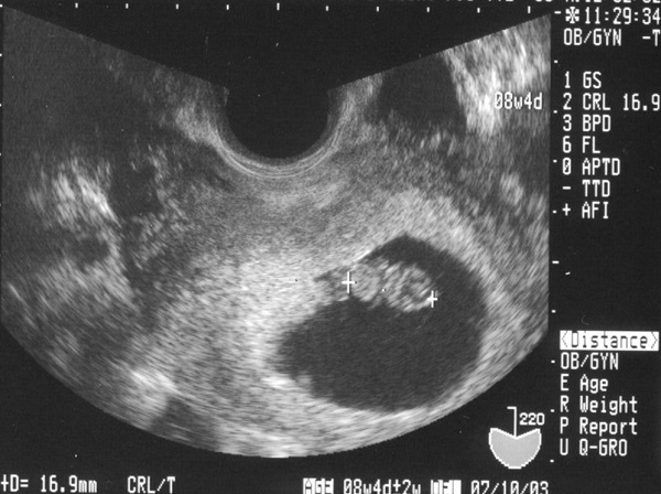 hình ảnh siêu âm thai 6 tuần tuổi