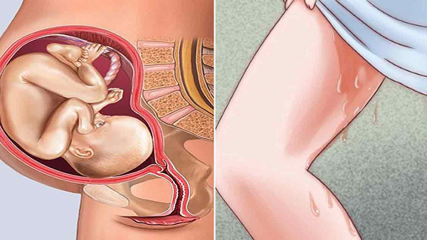 Rỉ ối non là hiện tượng túi ối bị vỡ thai nhi chưa đủ 37 tuần tuổi